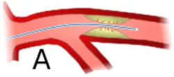 Angioplasty Cost India, cost of heart angioplasty in india, price of angioplasty procedure in India,