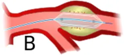 Angioplasty Intervention