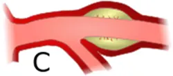 Angioplasty in India, coronary angioplasty surgery in  india,  Best Angioplasty Doctor in India