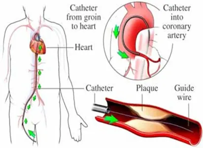 Angiography of Heart Cost in  India, Best Heart Treatment in India, Angiography in India, Angiography treatment in india