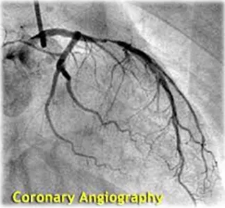 Angiography in India, Angiography treatment in india, Coronary Angiography Test Center in India