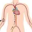 Coronary Angioplasty In India, Coronary Angioplasty Procedure In India, Coronary Angioplasty Cost In India