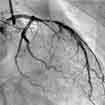 Coronary Angiography In India, Coronary Angiography Procedure In India, Coronary Angiography Cost In India