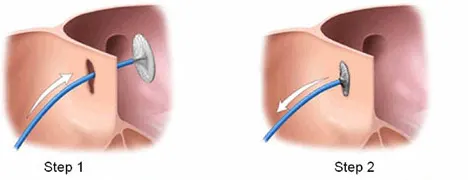 ASD/VSD closure, ASD/VSD closure in Indian hospitals, ASD/VSD closure in India, open heart surgery in India