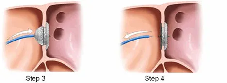 ASD/VSD closure, ASD/VSD closure in Indian hospitals, ASD/VSD closure in India, open heart surgery in India