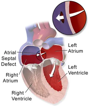 ASD closure surgery in india, Cost of ASD closure surgery in india, VSD closure surgery in india, Atrial Septal Defect Closure in India