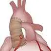 Bentall Surgery In India, Bentall Surgery Cost In India