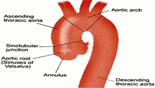 Bentall Surgery Cost In India, Bentall Procedure Cost In India