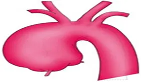 Bentall Surgery In India, Best Bentall Procedure Hospital In India