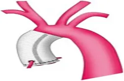 Bentall Surgery in india,  Bentall Surgery Cost in india