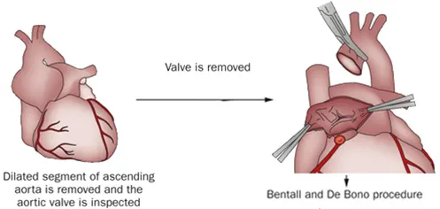 Bentall Surgery in india, bentall procedure cost in india, Best cost for Bentall surgery In India
