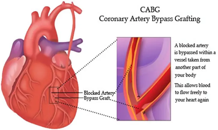 Bypass Surgery in India, cost of bypass surgery in india, cabg cost in india