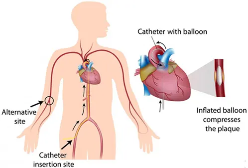coronary angioplasty surgery in  india,  Best Angioplasty Doctor in India, angioplasty treatment in India