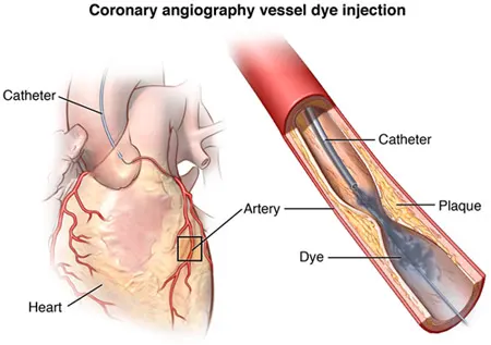Coronary angioplasty and stents, Cost of Stent and Angioplasty, Coronary Angioplasty in India, Percutaneous Transluminal Coronary Angioplasty In India