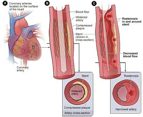 Cost of Coronary angioplasty, stents and Percutaneous Transluminal Coronary Angioplasty in India cardiology centres