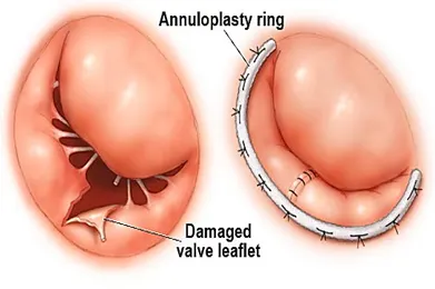 Heart valve replacement surgery hospital in india, low cost valve replacement surgery in india, Valve Surgeries in India