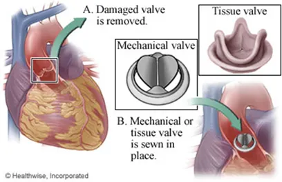 Heart Valve Replacement Surgery Cost in India, Heart Valve Replacement Surgery in India, Heart Valve Repair Surgery in India