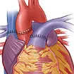Heart Transplant Surgery In India 